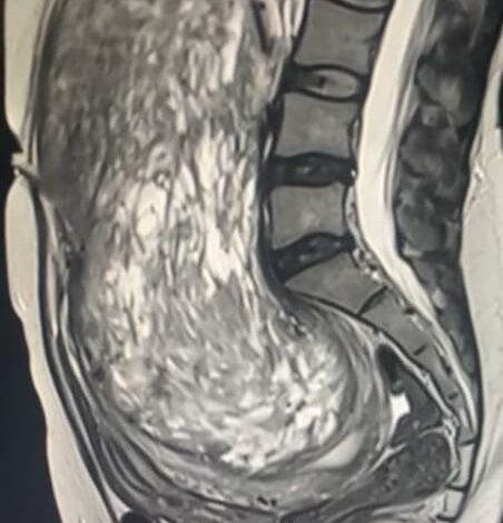 مدينة الملك عبدالله الطبية تنجح في استئصال ورم بحجم جنين من ثلاثينية سعودية