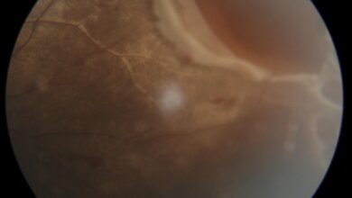 إنقاذ بصر صبي يبلغ من العمر 13 عاماً بعد إصابة نادرة في عينه بسبب كرة الكريكيت تم علاجه في مستشفى أستر منخول